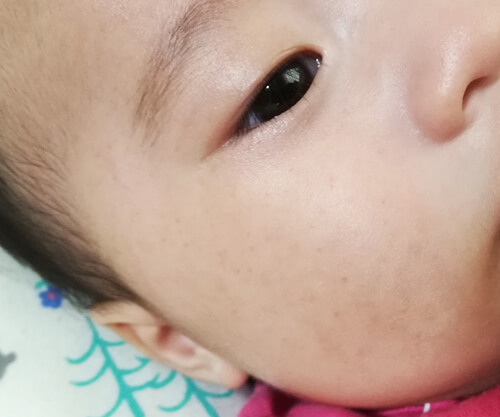 赤ちゃんの顔に内出血発生 赤ちゃんの顔に赤い斑点