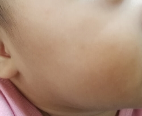 赤ちゃんの顔に内出血発生 赤ちゃんの顔に赤い斑点
