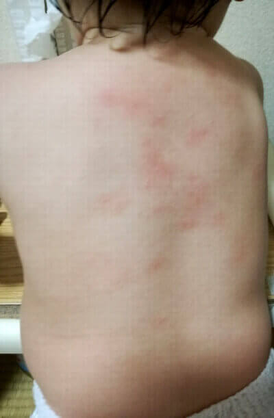赤ちゃん 背中 湿疹 赤ちゃんの背中に湿疹 ブツブツ 背中が赤い原因と対処法は